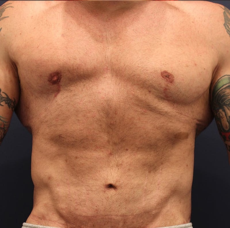 Male Breast Reduction Gynecomastia Before & After