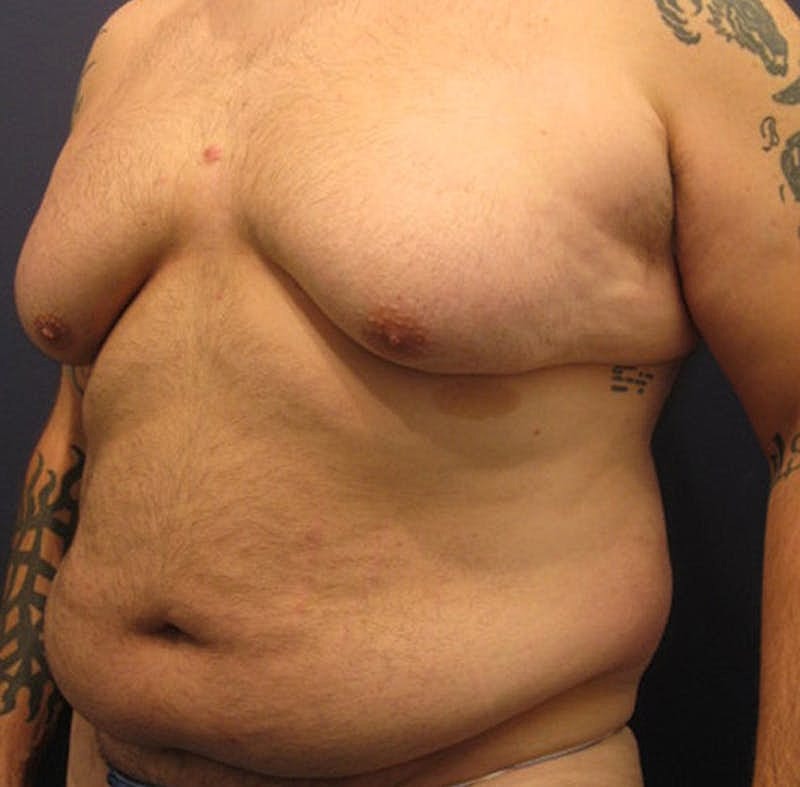 Male Breast Reduction Gynecomastia Before & After