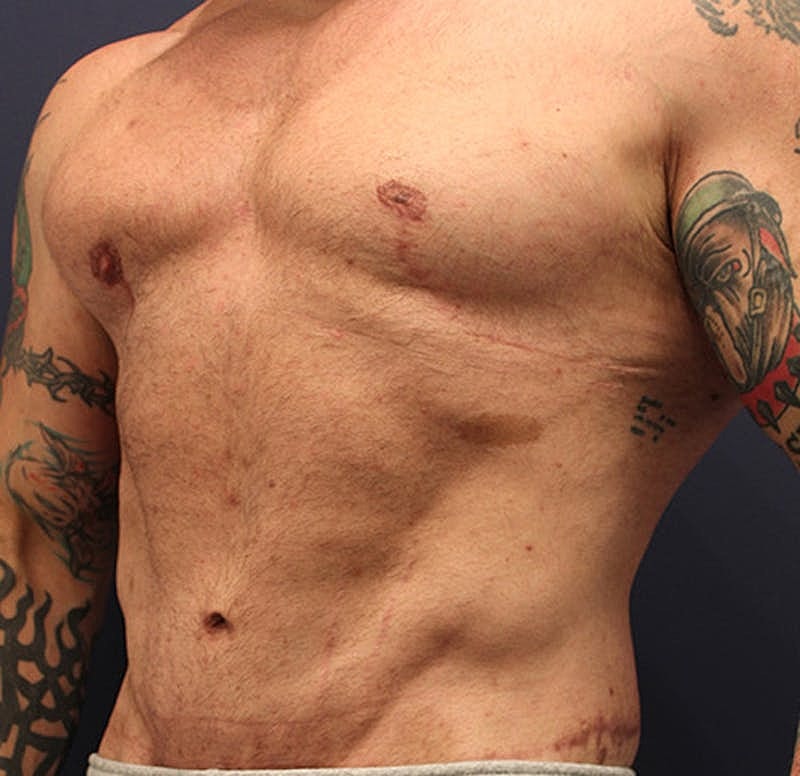 Male Breast Reduction Gynecomastia Before & After