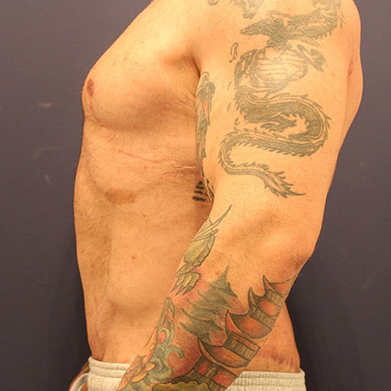 Male Breast Reduction Gynecomastia Before & After