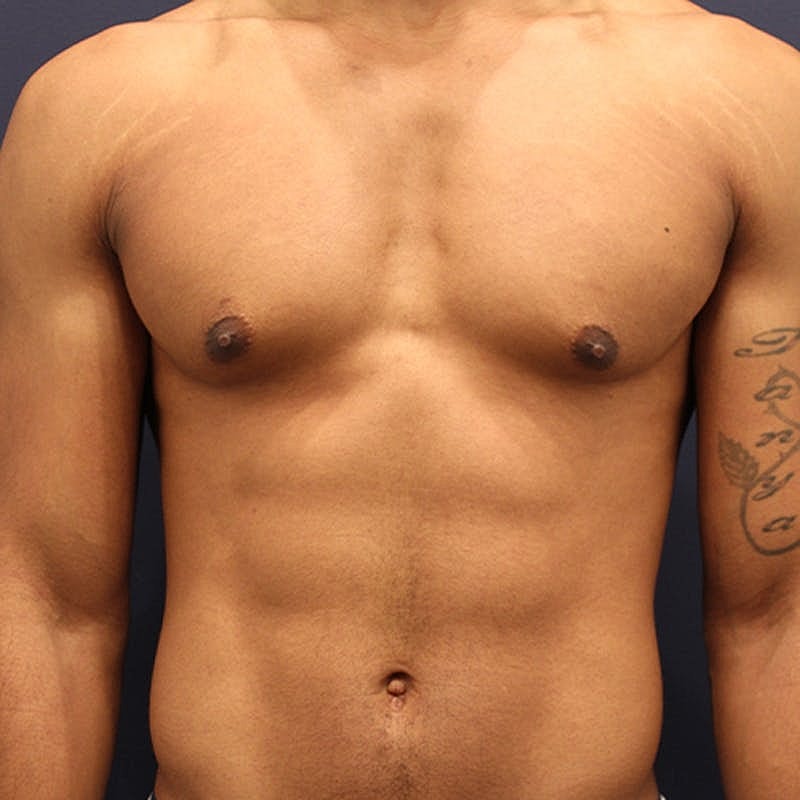 Male Breast Reduction Gynecomastia Before & After