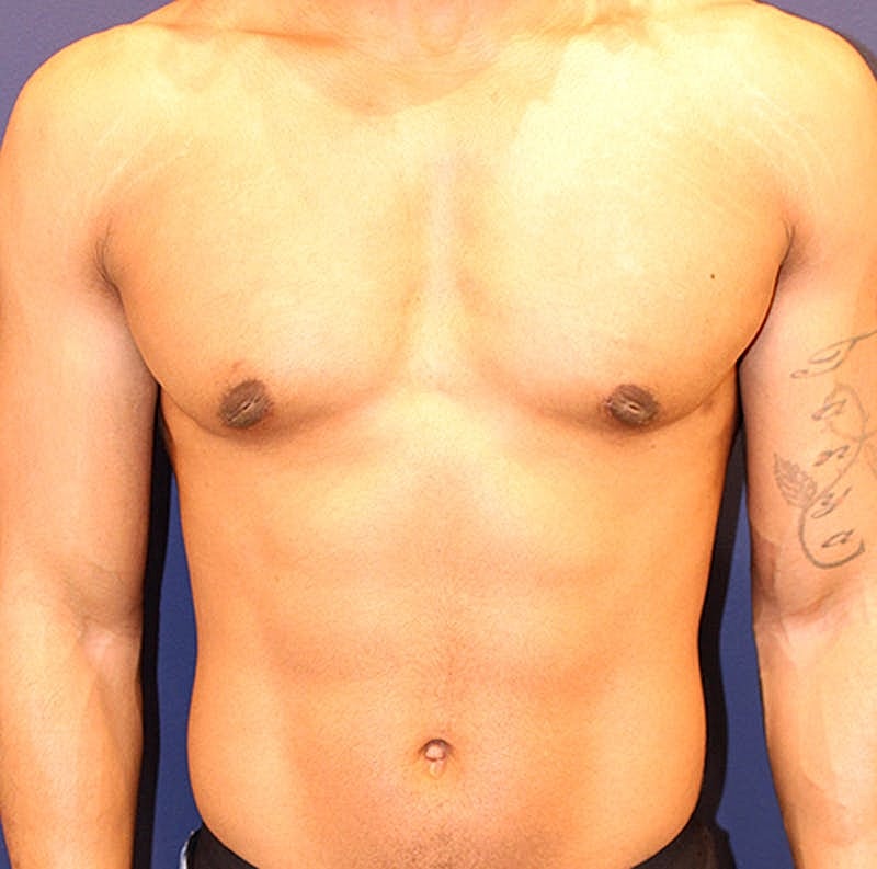Male Breast Reduction Gynecomastia Before & After