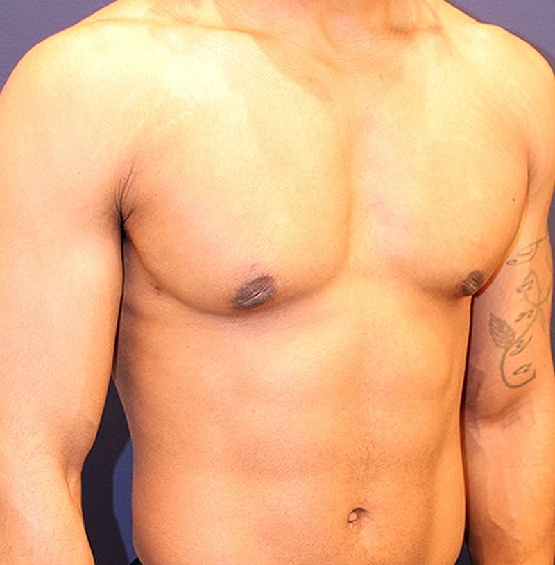Male Breast Reduction Gynecomastia Before & After