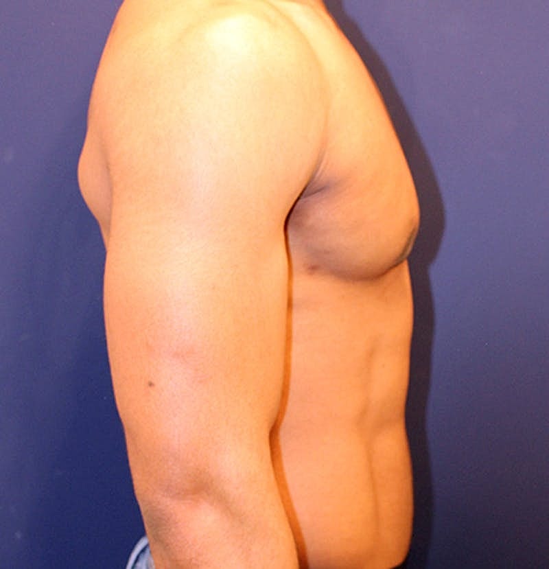 Male Breast Reduction Gynecomastia Before & After