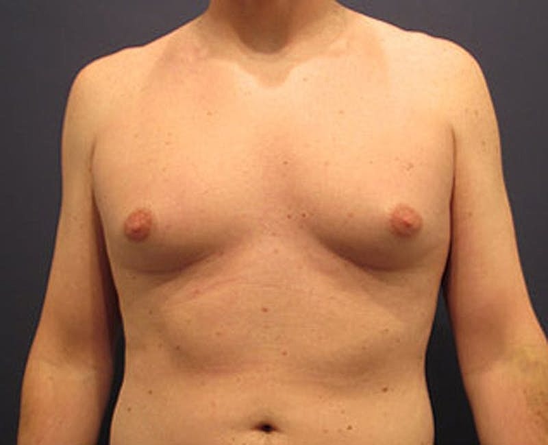 Male Breast Reduction Gynecomastia Before & After