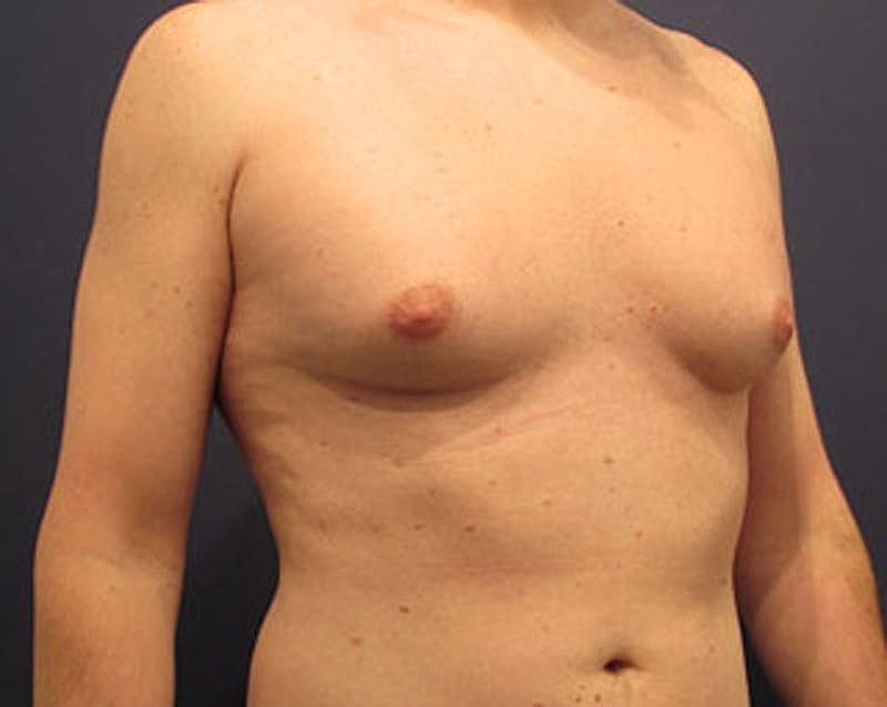 Male Breast Reduction Gynecomastia Before & After