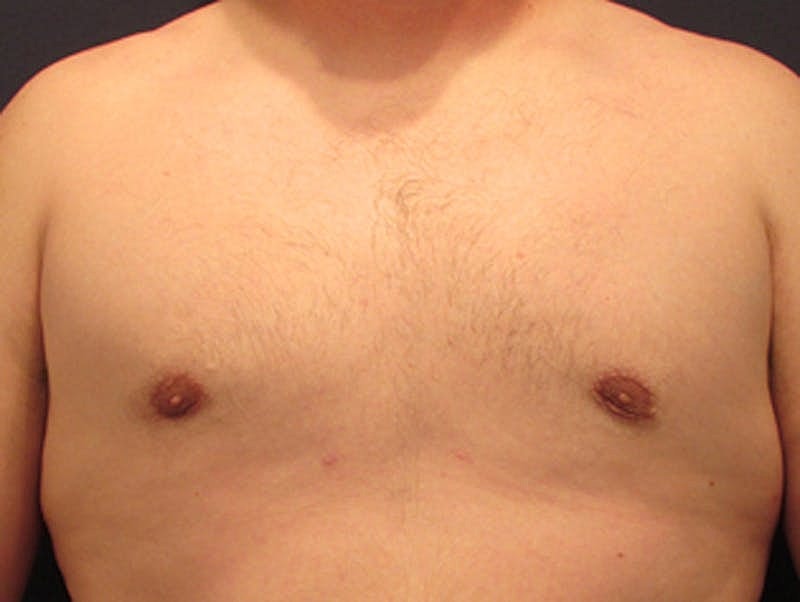 Male Breast Reduction Gynecomastia Before & After