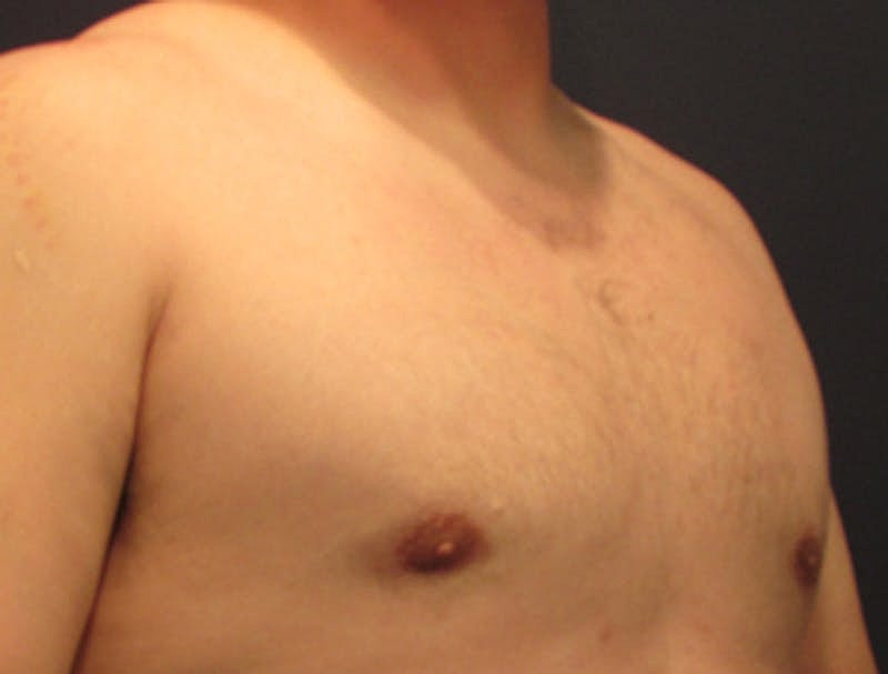 Male Breast Reduction Gynecomastia Before & After