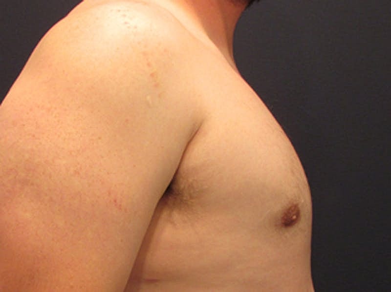 Male Breast Reduction Gynecomastia Before & After