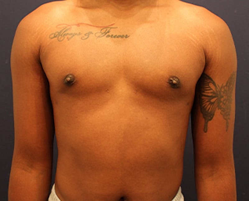 Male Breast Reduction Gynecomastia Before & After