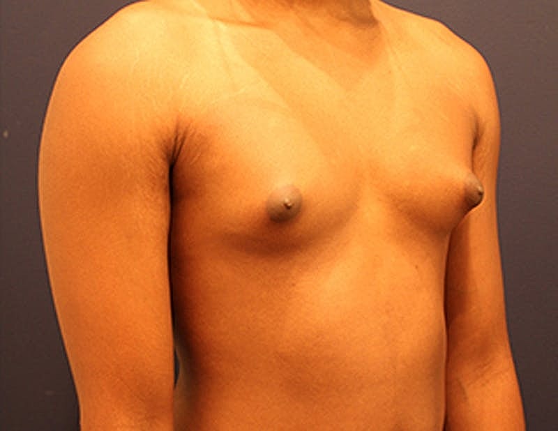 Male Breast Reduction Gynecomastia Before & After