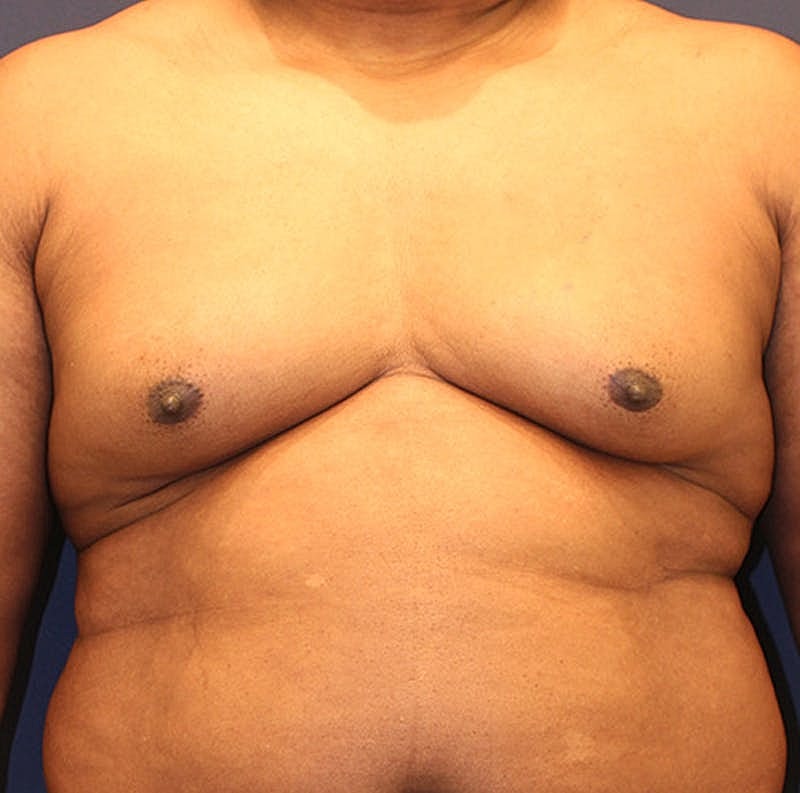 Male Breast Reduction Gynecomastia Before & After