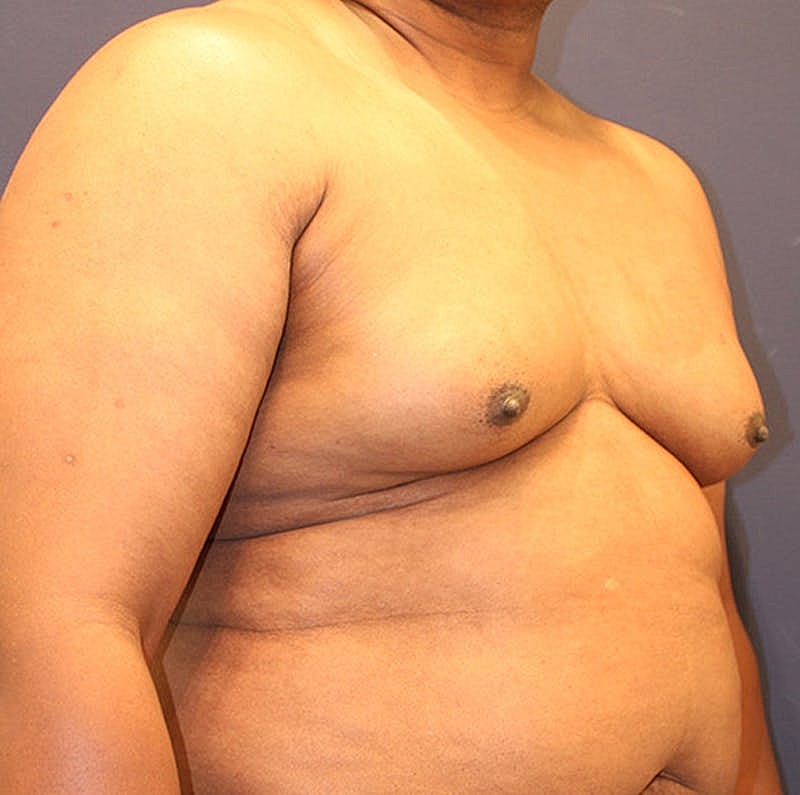 Male Breast Reduction Gynecomastia Before & After