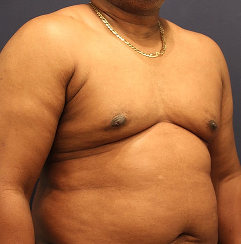 Male Breast Reduction Gynecomastia Before & After