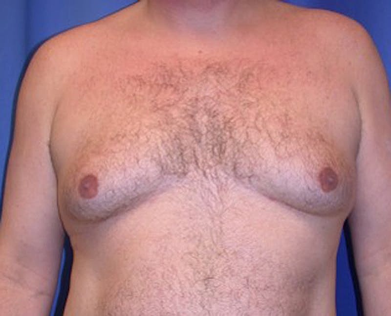 Male Breast Reduction Gynecomastia Before & After