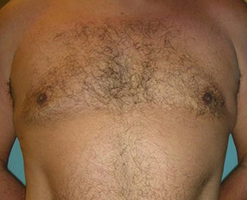 Male Breast Reduction Gynecomastia Before & After