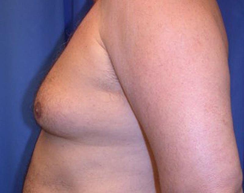 Male Breast Reduction Gynecomastia Before & After