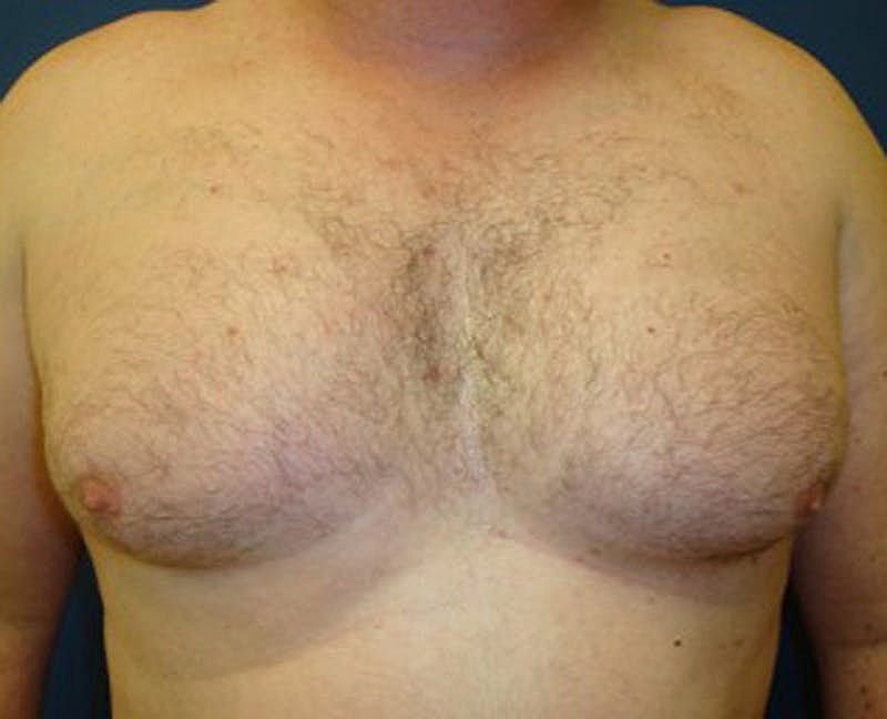 Male Breast Reduction Gynecomastia Before & After