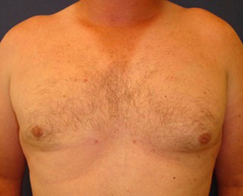 Male Breast Reduction Gynecomastia Before & After