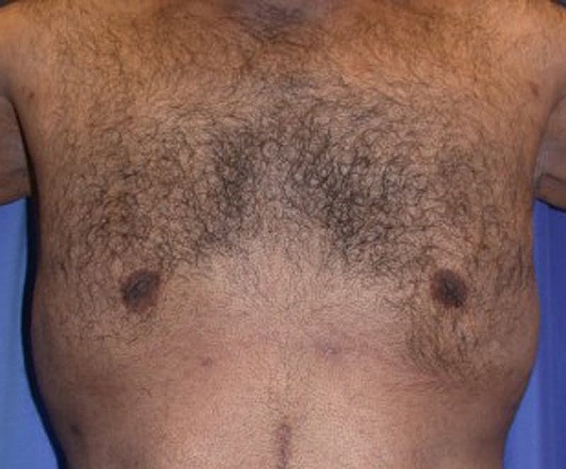 Male Breast Reduction Gynecomastia Before & After