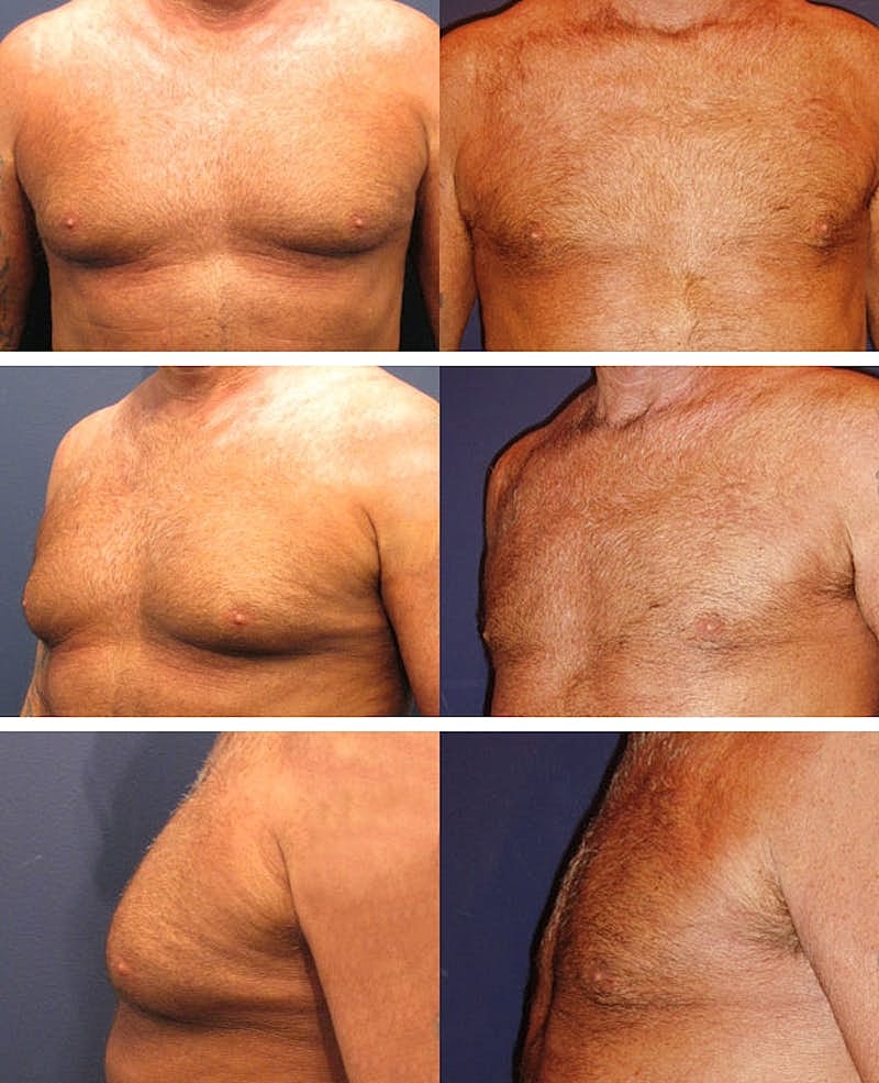 Male Breast Reduction Gynecomastia Before & After