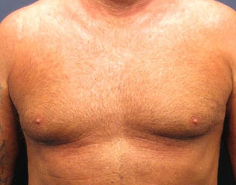 Male Breast Reduction Gynecomastia Before & After