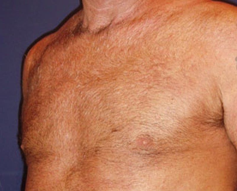 Male Breast Reduction Gynecomastia Before & After