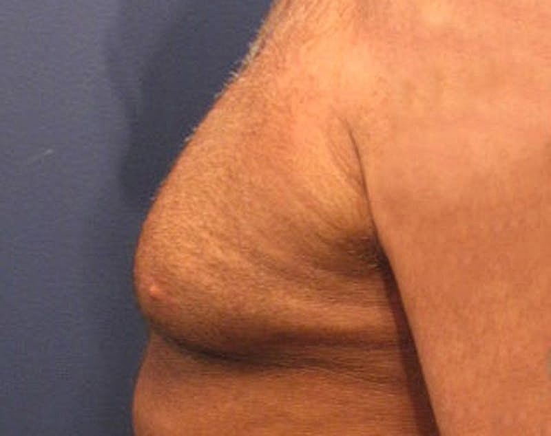 Male Breast Reduction Gynecomastia Before & After