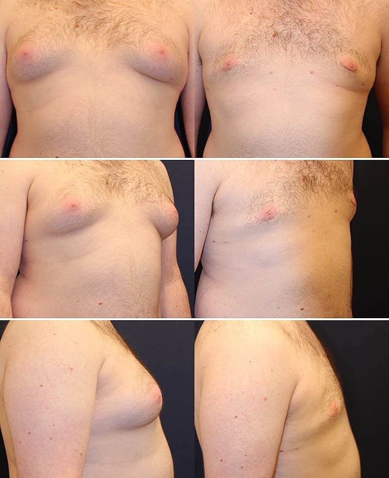 Male Breast Reduction Gynecomastia Before & After