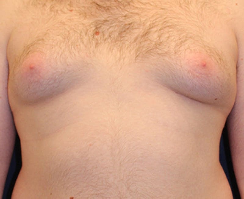 Male Breast Reduction Gynecomastia Before & After