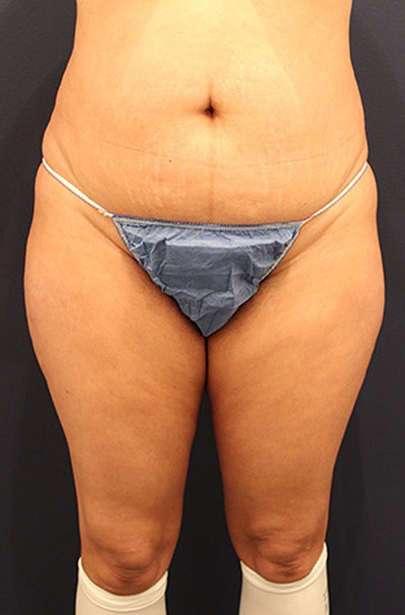 Brazilian Butt Lift Before & After