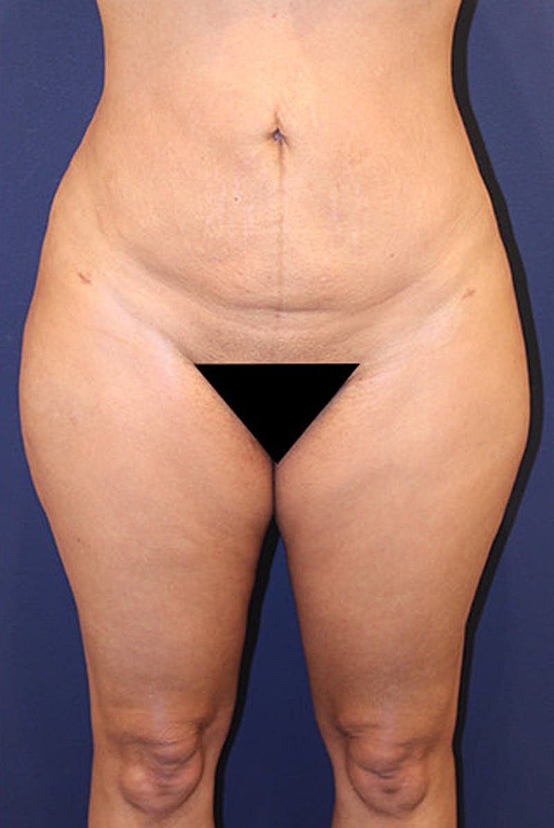 Brazilian Butt Lift Before & After