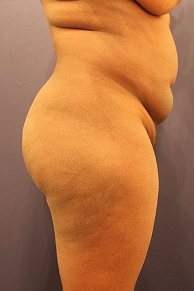 Brazilian Butt Lift Before & After