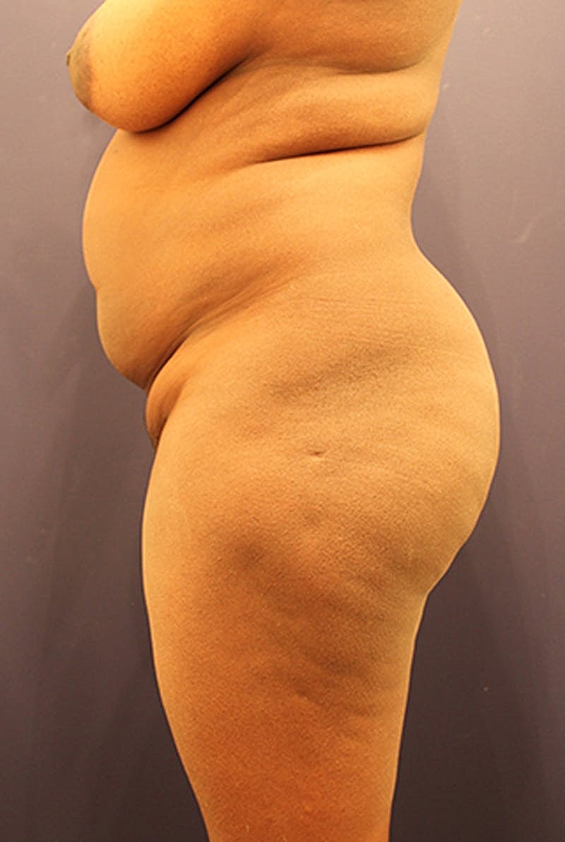 Brazilian Butt Lift Before & After