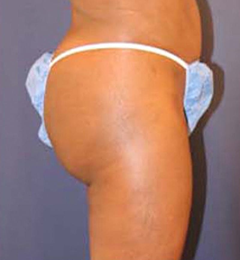 Brazilian Butt Lift Before & After