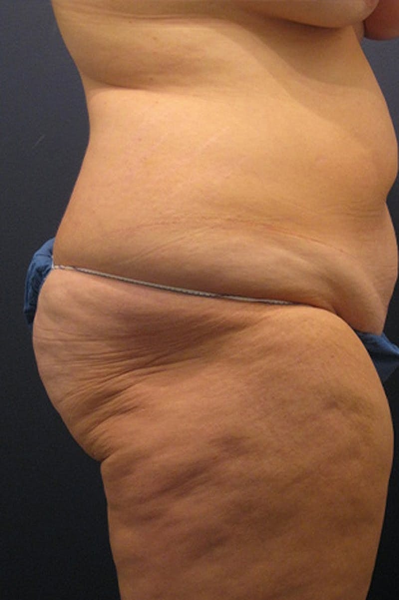 Brazilian Butt Lift Before & After