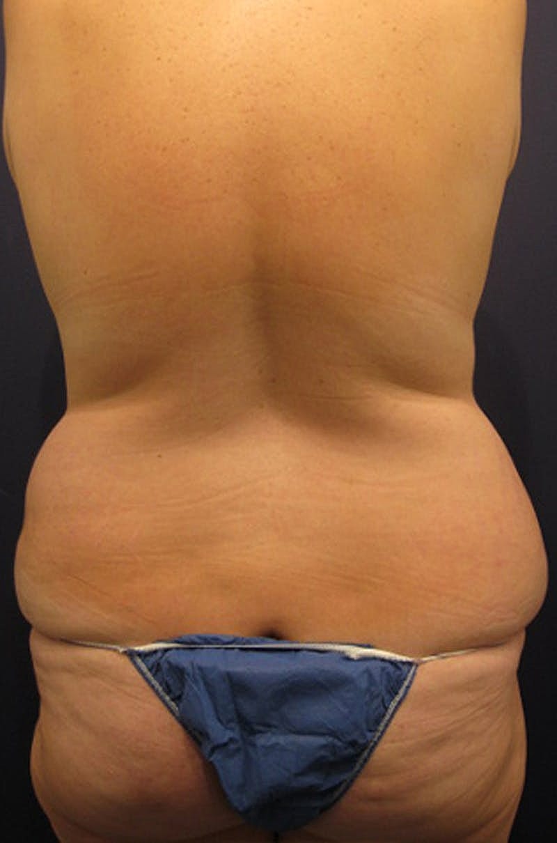 Brazilian Butt Lift Before & After