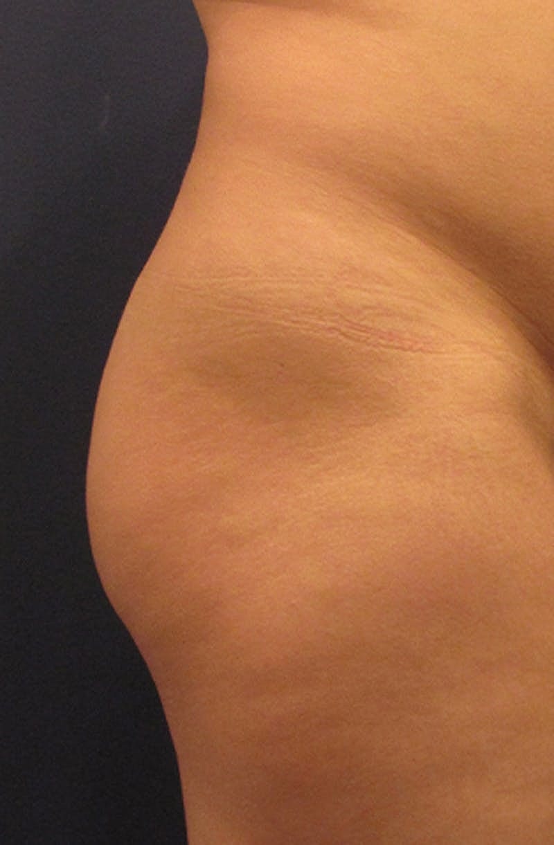 Brazilian Butt Lift Before & After