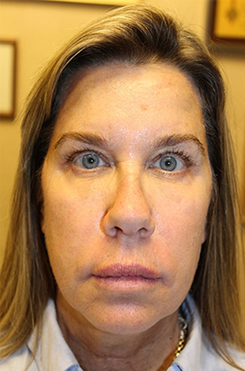 Jeuveau Before & After