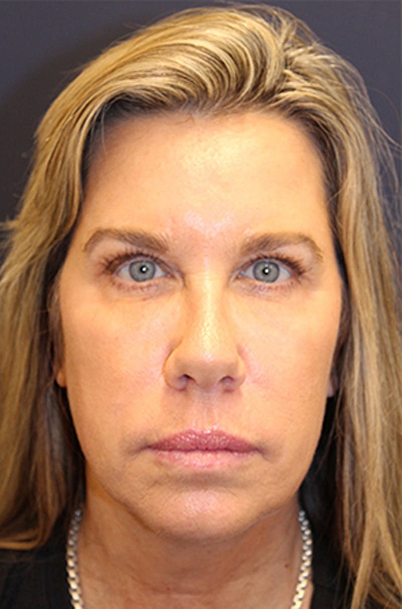 Jeuveau Before & After