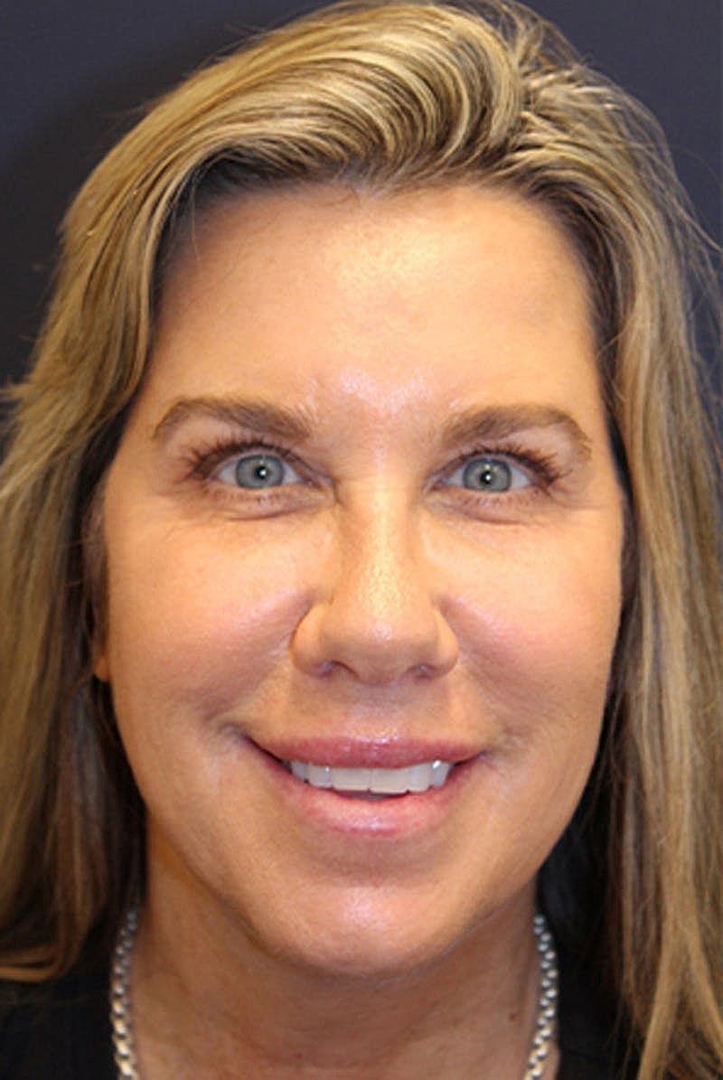 Jeuveau Before & After