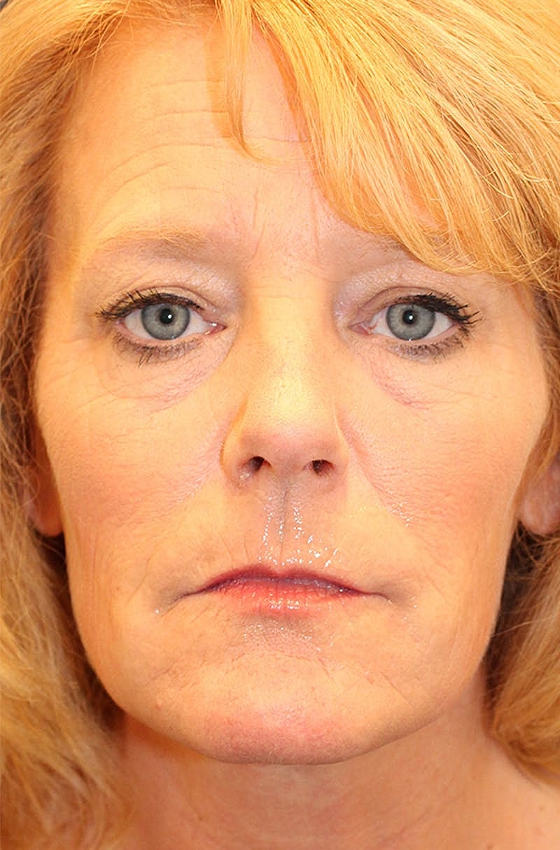 Jeuveau Before & After