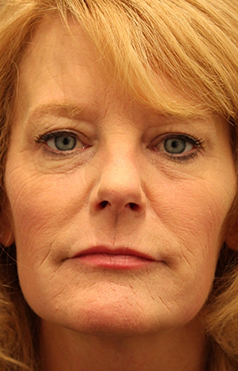 Jeuveau Before & After