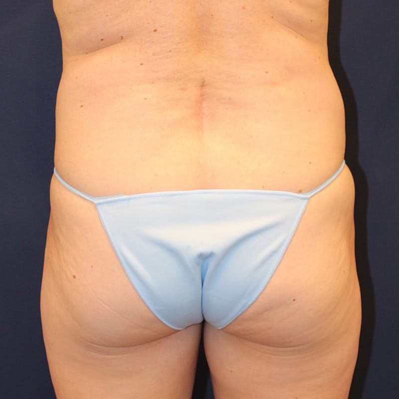 Tummy Tuck Before & After