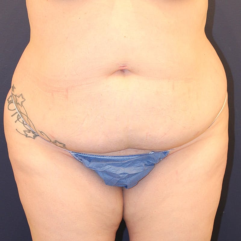 Tummy Tuck Before & After