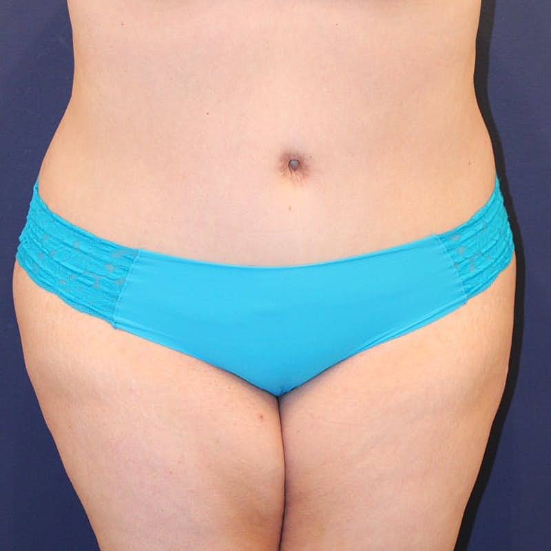 Tummy Tuck Before & After