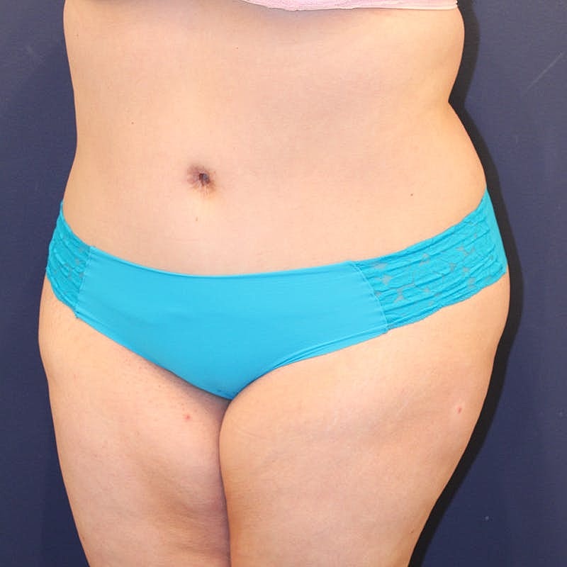 Tummy Tuck Before & After