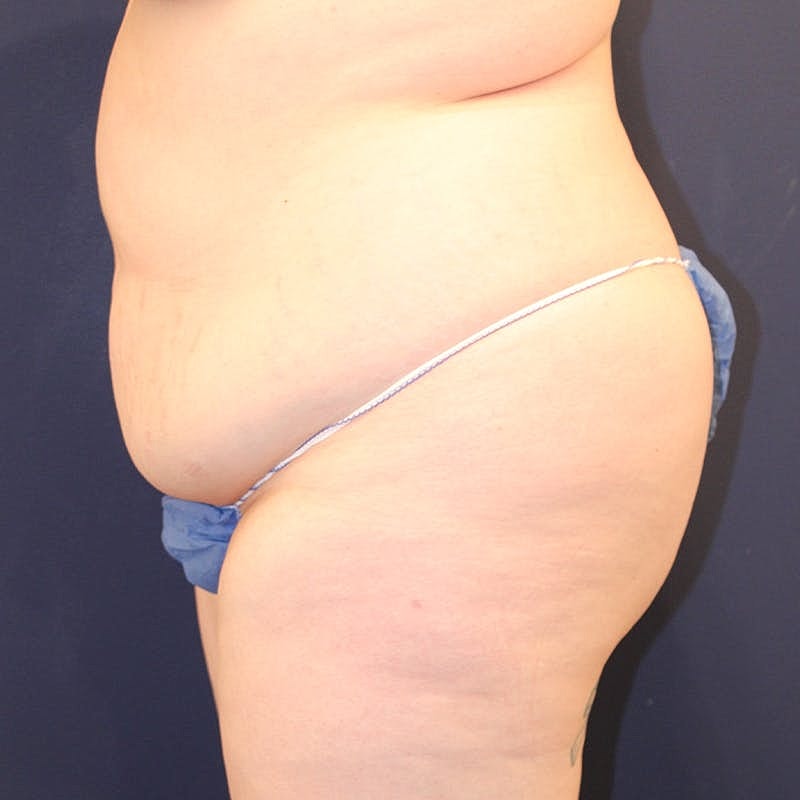 Tummy Tuck Before & After