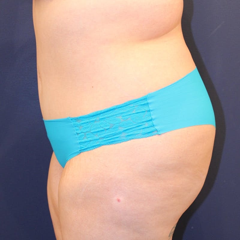 Tummy Tuck Before & After