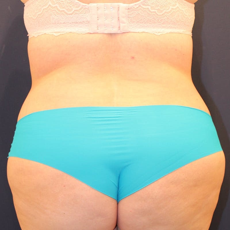 Tummy Tuck Before & After